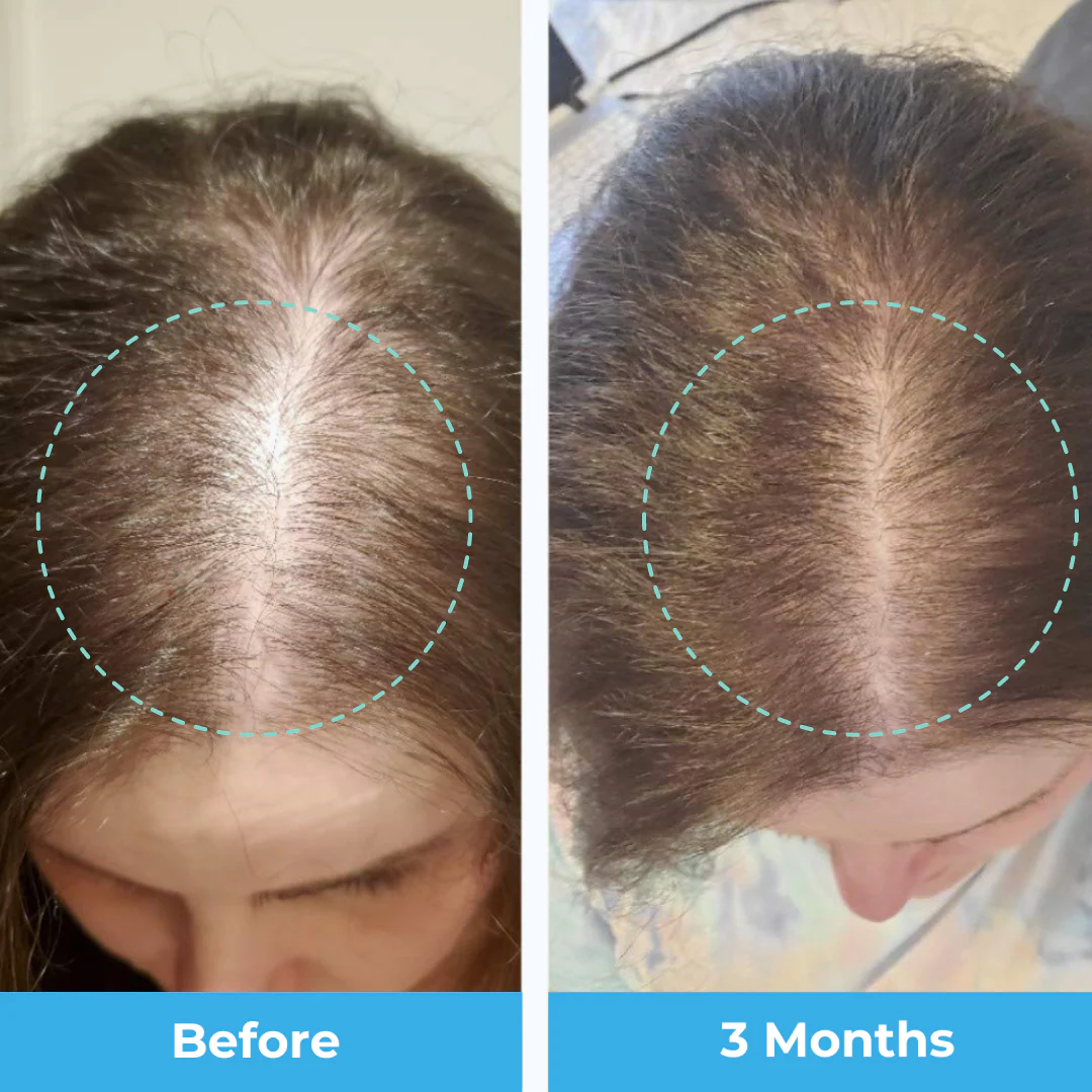 Postpartum Hair Loss Vitamins - Image 4